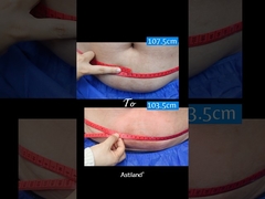 지방을 동결시켜 1시간에 4cm를 잃어!