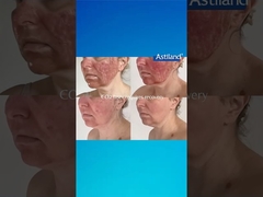 HIFU 대 분자산화탄소 레이저, 어느 쪽을 더 좋아하시나요?