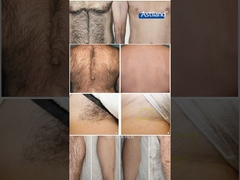 레이저 탈모 이전과 후